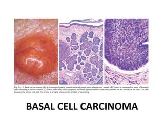 BASAL CELL CARCINOMA
 