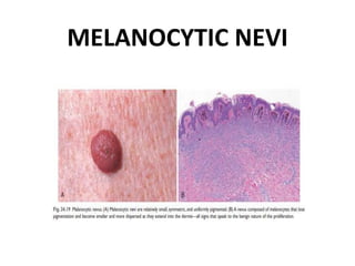 MELANOCYTIC NEVI
 