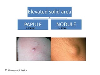 Elevated solid area
PAPULE NODULE
=< 5mm > 5mm
 Macroscopic lesion
 