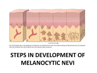 STEPS IN DEVELOPMENT OF
MELANOCYTIC NEVI
 