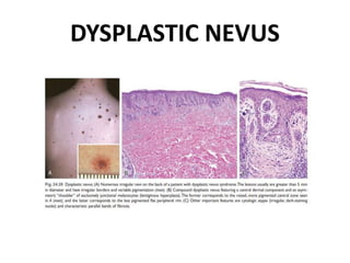 DYSPLASTIC NEVUS
 