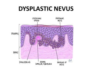 DYSPLASTIC NEVUS
 