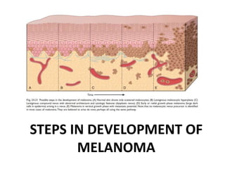 STEPS IN DEVELOPMENT OF
MELANOMA
 