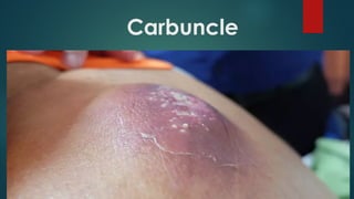 Forearm Carbuncle Skin-and-soft-tissue-infections-5.ppt... | PPT