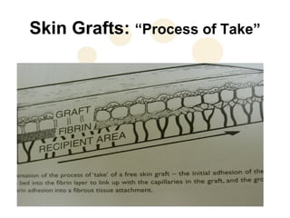 Skin Grafts: “Process of Take”
 