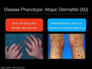 The Role of the Skin Microbiome in Atopic Dermatitis (Eczema) | PDF