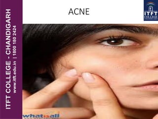ACNE
 