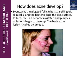 How does acne develop?
• Eventually, the plugged follicle bursts, spilling oil,
skin cells, and the bacteria onto the skin surface.
In turn, the skin becomes irritated and pimples
or lesions begin to develop. The basic acne
lesion is called a comedo.
 