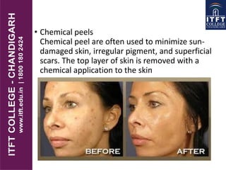 • Chemical peels
Chemical peel are often used to minimize sun-
damaged skin, irregular pigment, and superficial
scars. The top layer of skin is removed with a
chemical application to the skin
 