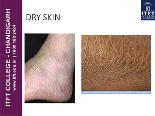 DRY SKIN
 
