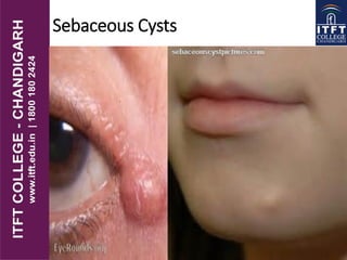 Sebaceous Cysts
 