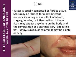 SCAR
• A scar is usually composed of fibrous tissue.
Scars may be formed for many different
reasons, including as a result of infections,
surgery, injuries, or inflammation of tissue.
Scars may appear anywhere on the body, and
the composition of a scar may vary--appearing
flat, lumpy, sunken, or colored. It may be painful
or itchy
 