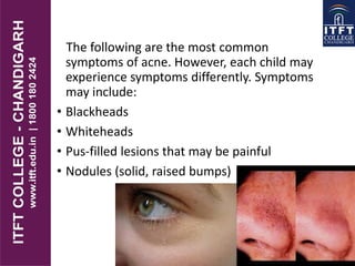 The following are the most common
symptoms of acne. However, each child may
experience symptoms differently. Symptoms
may include:
• Blackheads
• Whiteheads
• Pus-filled lesions that may be painful
• Nodules (solid, raised bumps)
 