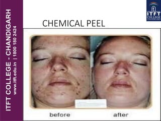 CHEMICAL PEEL
 