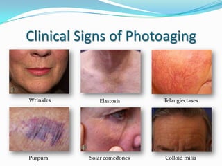 Clinical Signs of Photoaging

Wrinkles

Elastosis

Telangiectases

Purpura

Solar comedones

Colloid milia

 