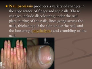 Nail psoriasis produces a variety of changes in
the appearance of finger and toe nails. These
changes include discolouring under the nail
plate, pitting of the nails, lines going across the
nails, thickening of the skin under the nail, and
the loosening (onycholysis) and crumbling of the
nail.
 