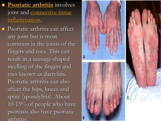  Psoriatic arthritis involves
joint and connective tissue
inflammation.
 Psoriatic arthritis can affect
any joint but is most
common in the joints of the
fingers and toes. This can
result in a sausage-shaped
swelling of the fingers and
toes known as dactylitis.
Psoriatic arthritis can also
affect the hips, knees and
spine (spondylitis). About
10-15% of people who have
psoriasis also have psoriatic
 
