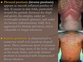  Flexural psoriasis (inverse psoriasis)
appears as smooth inflamed patches of
skin. It occurs in skin folds, particularly
around the genitals (between the thigh
and groin), the armpits, under an
overweight stomach (pannus), and under
the breasts (inframammary fold). It is
aggravated by friction and sweat, and is
vulnerable to fungal infections.
 Guttate psoriasis is characterized by
numerous small oval (teardrop-shaped)
spots. These numerous spots of psoriasis
appear over large areas of the body, such
as the trunk, limbs, and scalp. Guttate
psoriasis is associated with streptococcal
throat infection
 
