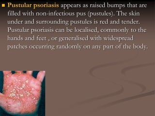  Pustular psoriasis appears as raised bumps that are
filled with non-infectious pus (pustules). The skin
under and surrounding pustules is red and tender.
Pustular psoriasis can be localised, commonly to the
hands and feet , or generalised with widespread
patches occurring randomly on any part of the body.
 