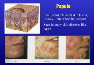 Small solid, elevated skin lesion,
usually 1 cm or less in diameter.
Seen in many skin diseases like
Acne
Papule
 