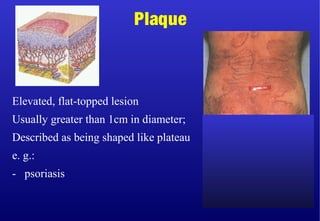 Elevated, flat-topped lesion
Usually greater than 1cm in diameter;
Described as being shaped like plateau
e. g.:
- psoriasis
Plaque
 
