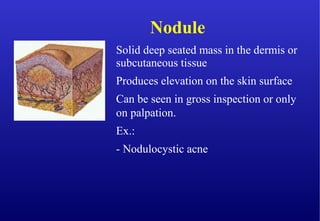 Solid deep seated mass in the dermis or
subcutaneous tissue
Produces elevation on the skin surface
Can be seen in gross inspection or only
on palpation.
Ex.:
- Nodulocystic acne
Nodule
 