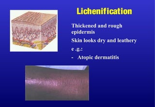Thickened and rough
epidermis
Skin looks dry and leathery
e .g.:
- Atopic dermatitis
Lichenification
 
