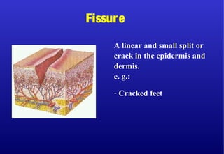 A linear and small split or
crack in the epidermis and
dermis.
e. g.:
- Cracked feet
Fissure
 