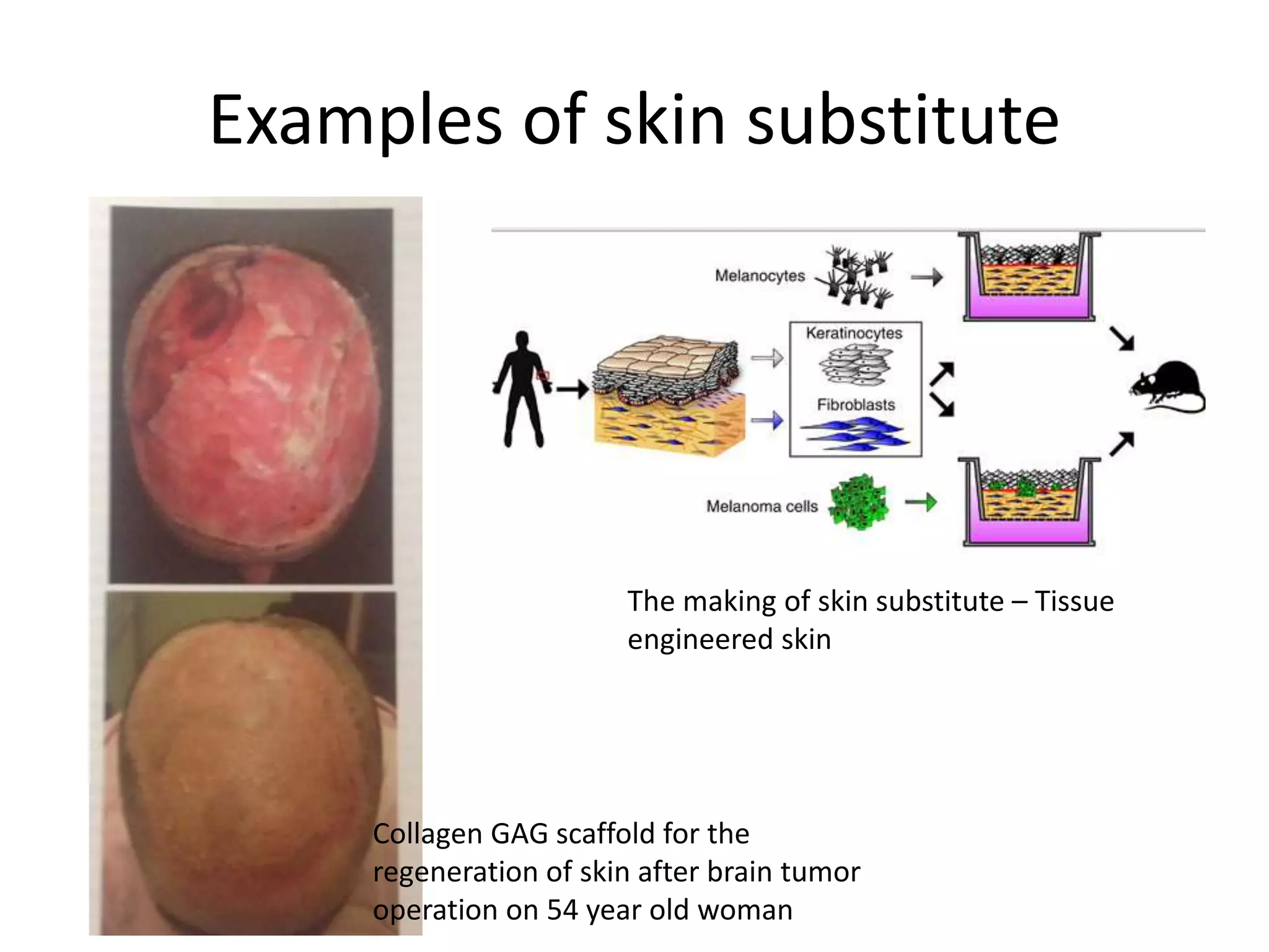 Examples of skin substitute
Collagen GAG scaffold for the
regeneration of skin after brain tumor
operation on 54 year old woman
The making of skin substitute – Tissue
engineered skin
 