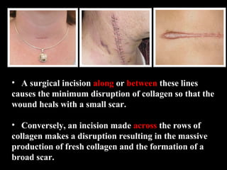 • A surgical incision along or between these lines
causes the minimum disruption of collagen so that the
wound heals with a small scar.
• Conversely, an incision made across the rows of
collagen makes a disruption resulting in the massive
production of fresh collagen and the formation of a
broad scar.
 