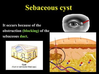 It occurs because of the
obstruction (blocking) of the
sebaceous duct.
Sebaceous cyst
 