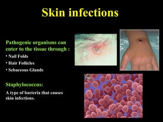 Skin infections
Pathogenic organisms can
enter to the tissue through :
• Nail Folds
• Hair Follicles
• Sebaceous Glands
Staphylococcus:
A type of bacteria that causes
skin infections.
 