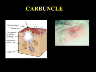 CARBUNCLE
 