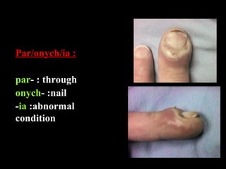Par/onych/ia :
par- : through
onych- :nail
-ia :abnormal
condition
 