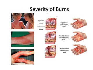 Severity of Burns
 