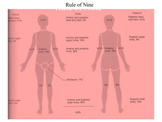 Rule of NineRule of Nine
 