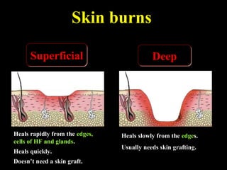 Skin burns
DeepDeepSuperficialSuperficial
Heals slowly from the edges.
Usually needs skin grafting.
Heals rapidly from the edges,
cells of HF and glands.
Heals quickly.
Doesn’t need a skin graft.
 