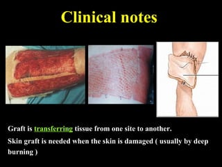 Clinical notes
Graft is transferring tissue from one site to another.
Skin graft is needed when the skin is damaged ( usually by deep
burning )
 