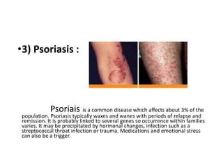 •3) Psoriasis :
Psoriais is a common disease which affects about 3% of the
population. Psoriasis typically waxes and wanes with periods of relapse and
remission. It is probably linked to several genes so occurrence within families
varies. It may be precipitated by hormonal changes, infection such as a
streptococcal throat infection or trauma. Medications and emotional stress
can also be a trigger.
 
