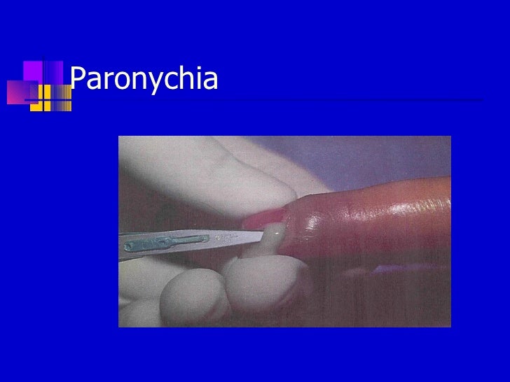 Skin And Soft Tissue Infections