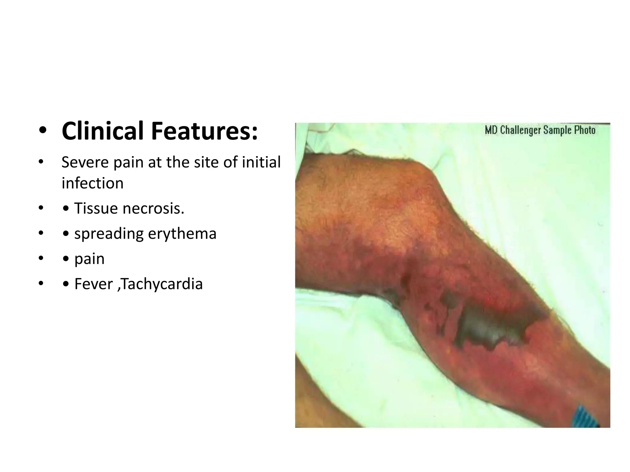 • Clinical Features:
• Severe pain at the site of initial
infection
• • Tissue necrosis.
• • spreading erythema
• • pain
• • Fever ,Tachycardia
 