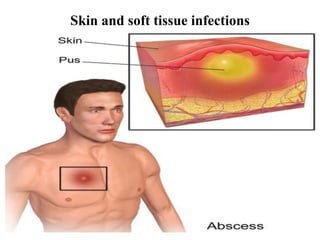 Skin and soft tissue infections
 