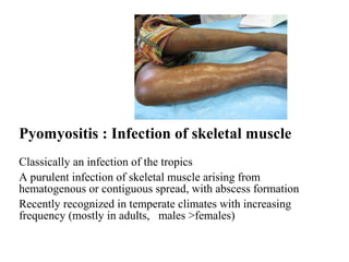 Infectious Pyomyositis Skin and soft tissue infections 26 march 18 | PPT