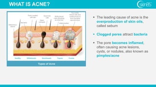 WHAT IS ACNE?
 The leading cause of acne is the
overproduction of skin oils,
called sebum
 Clogged pores attract bacteria
 The pore becomes inflamed,
often causing acne lesions,
cysts, or nodules, also known as
pimples/acne
 