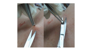 How and when to do a skin biopsy? Its indications, types sites | PPTX