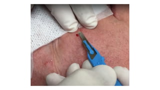 How and when to do a skin biopsy? Its indications, types sites | PPTX