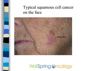 Squamous Cell Carcinoma Squamous cell carcinoma (SCC):  About 16% of diagnosed skin cancers are SCC. This cancer begins in the squamous cells, which are found in the upper layer of the epidermis. SCC tends to develop in fair-skinned middle-aged and elderly people who have had long-term sun exposure. It most often appears as a crusted or scaly area of skin with a red inflamed base that resembles a growing tumor, non-healing ulcer, or crusted-over patch of skin. While most commonly found on sun-exposed areas of the body, it can develop anywhere, including the inside of the mouth and the genitalia. SCC requires early treatment to prevent metastasis (spreading).  