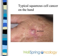 Typical squamous cell cancer on the ear 