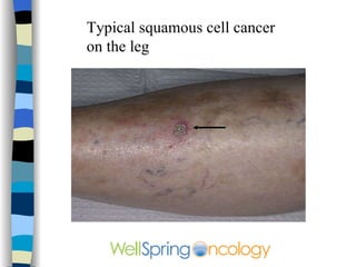Typical squamous cell cancer on the face and scalp 