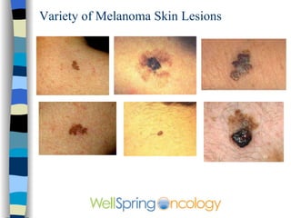 Typical squamous cell cancer on the hand 